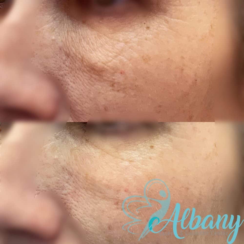 Undereye wrinkles correction with laser Cases 1017 Albany Laser