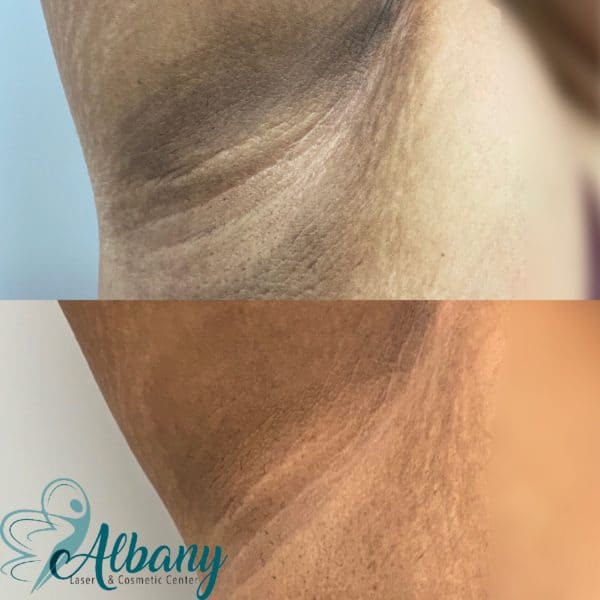 Underarm whitening Edmonton