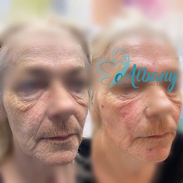 face fillers face lift