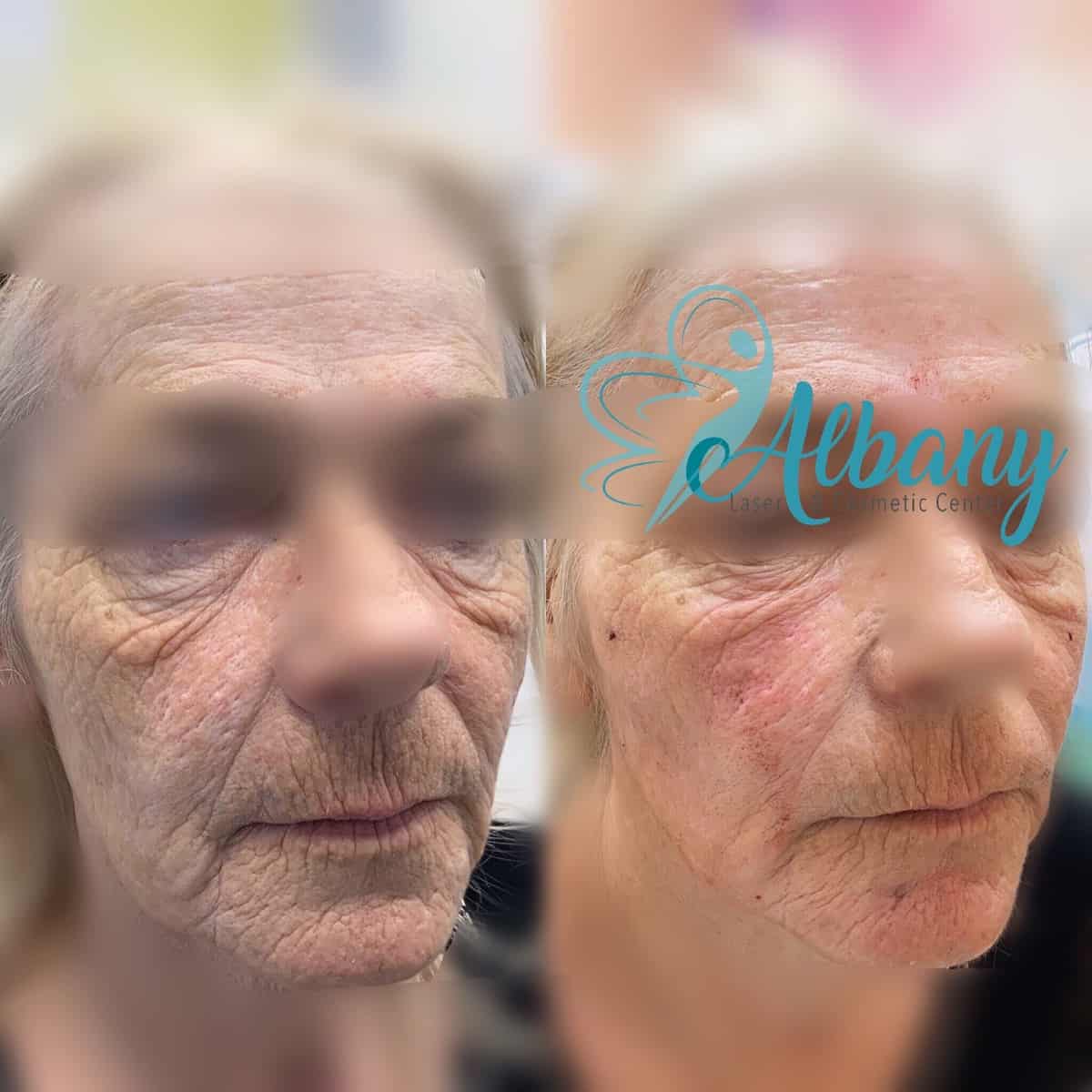 face fillers facelift
