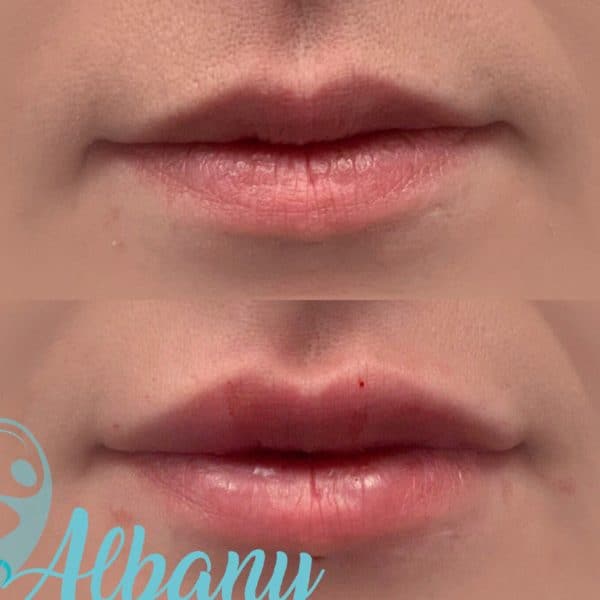 Lip fillers Restylane Edmonton