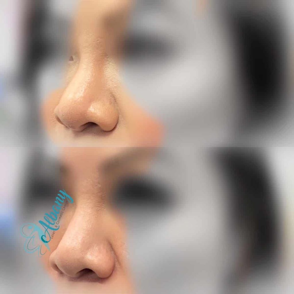 rhinoplasty with fillers