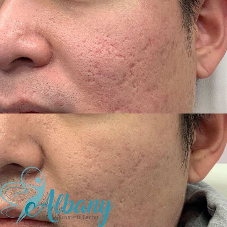Acne Scars treatment with Fractora Microneedling
