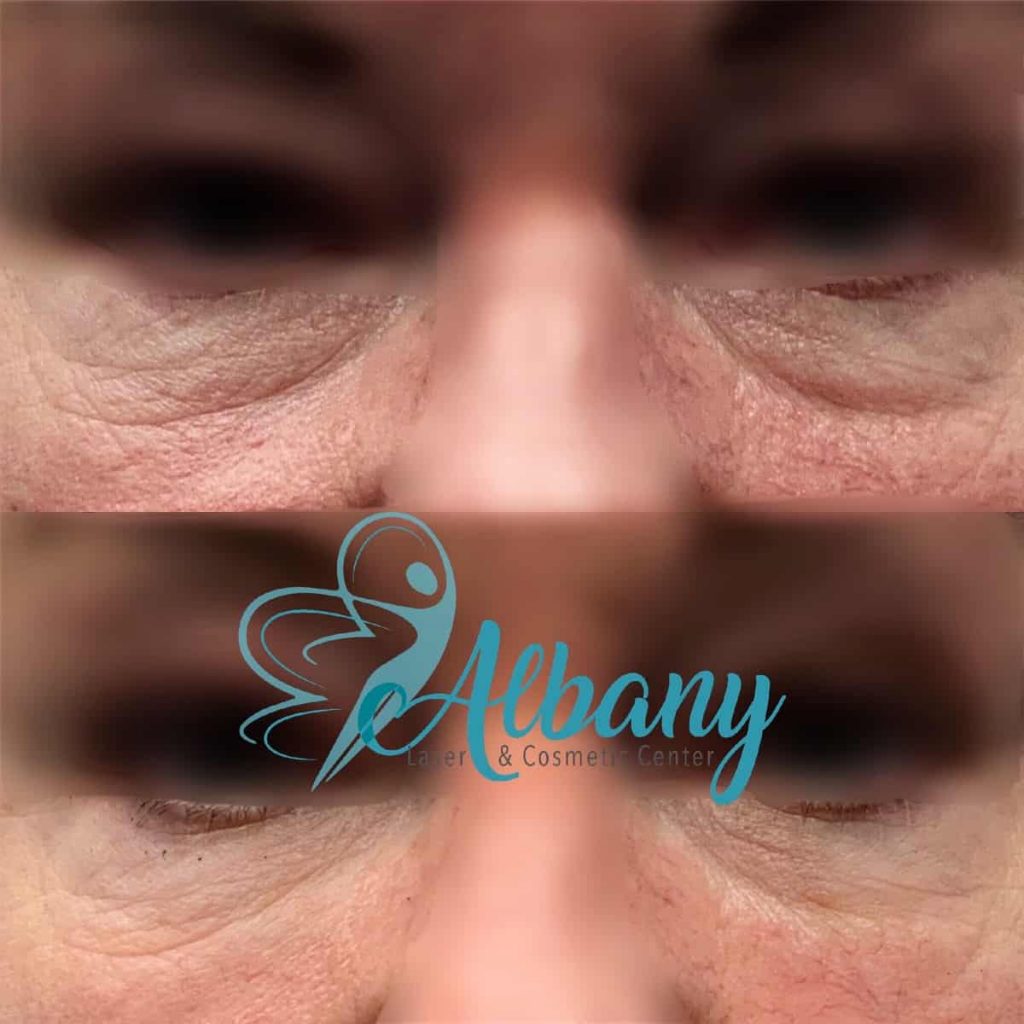 under eye filler Edmonton