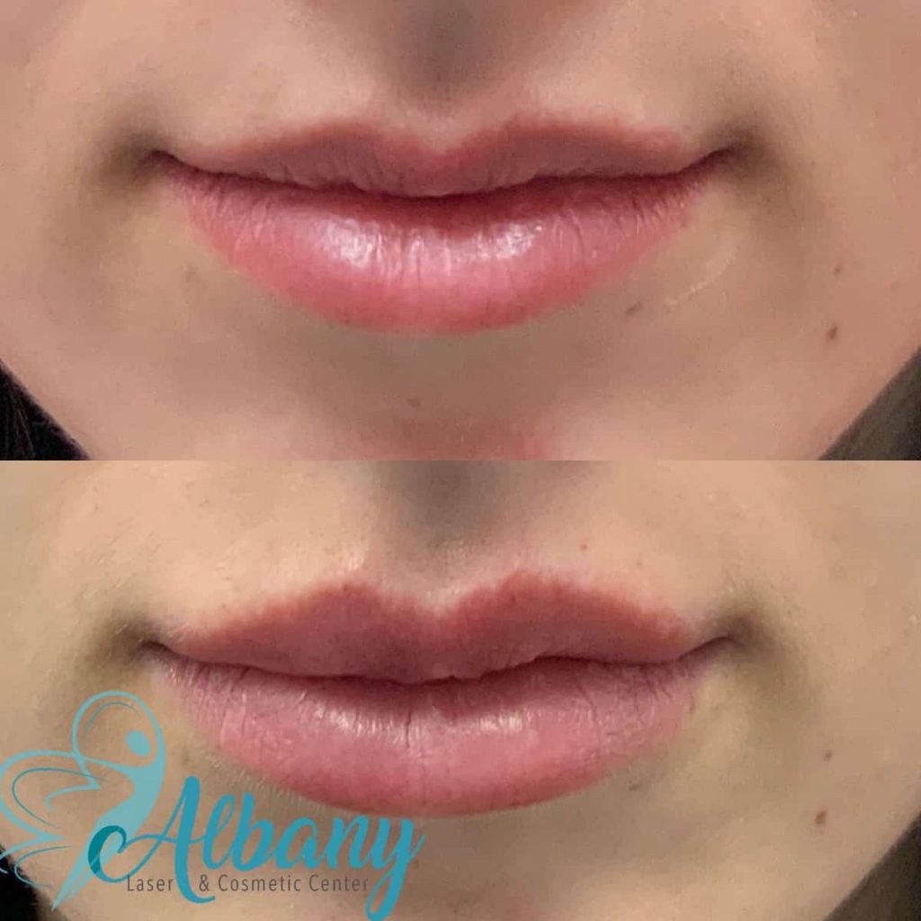 Lip filler injections