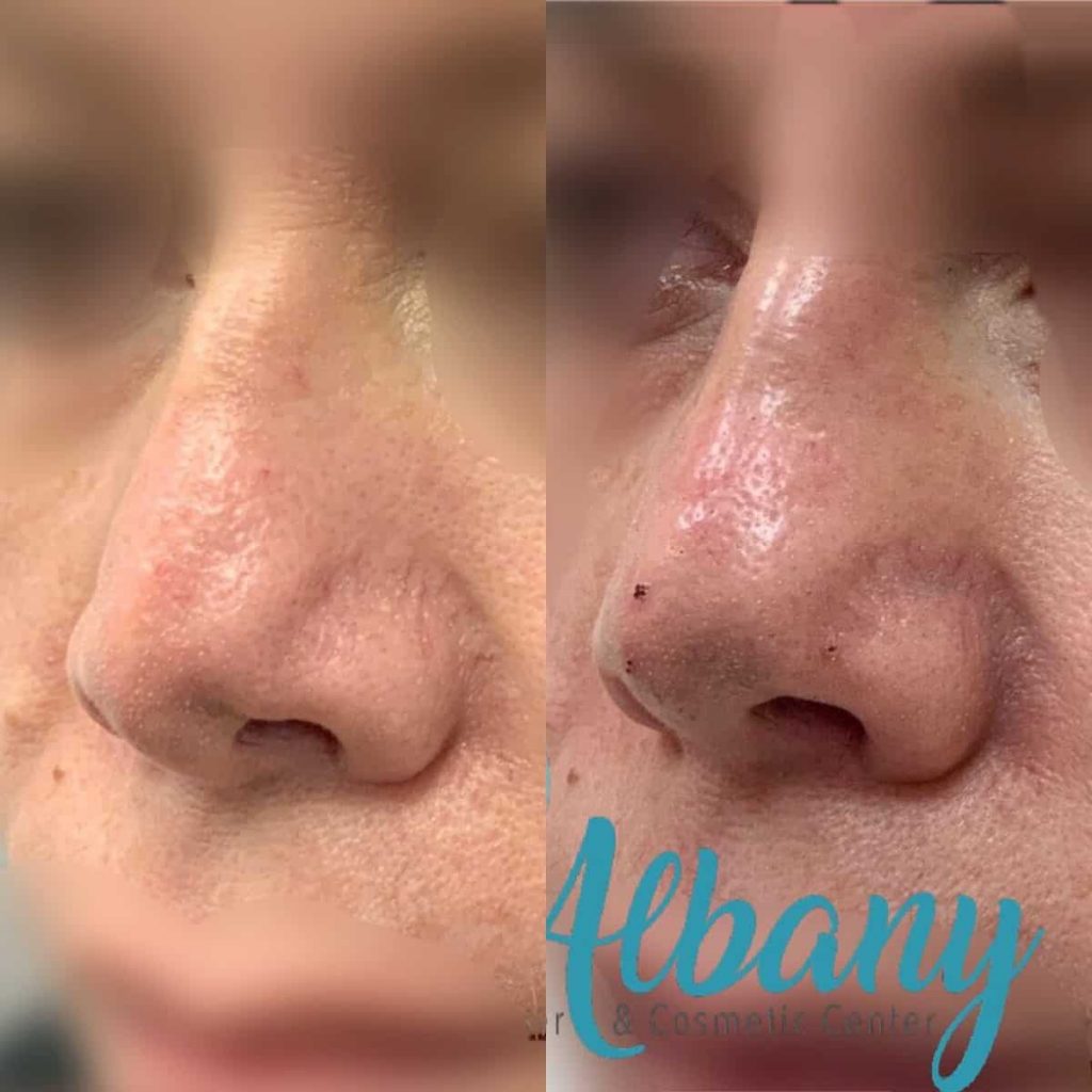 Nose job fillers Edmonton