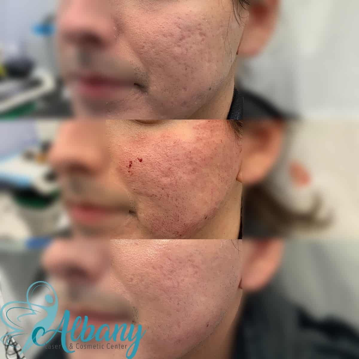 Microneedling acne scars