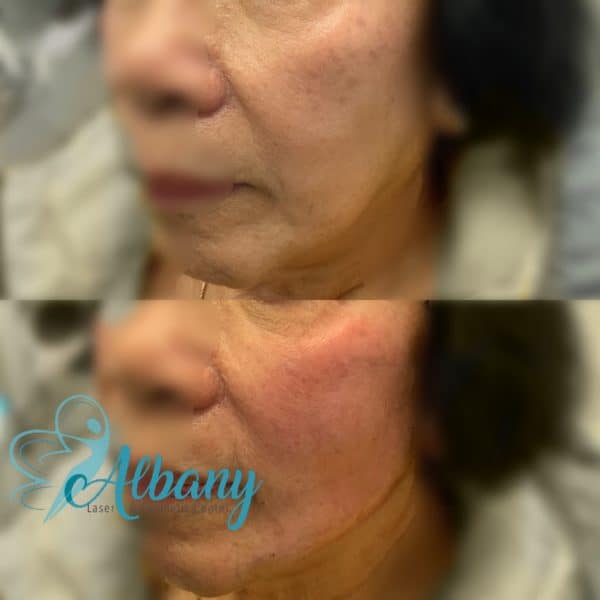 Facelift in Edmonton