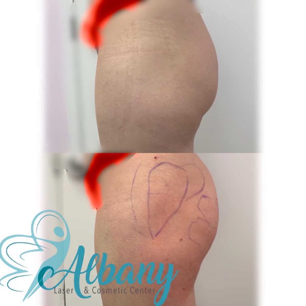 Sculptra For BBL