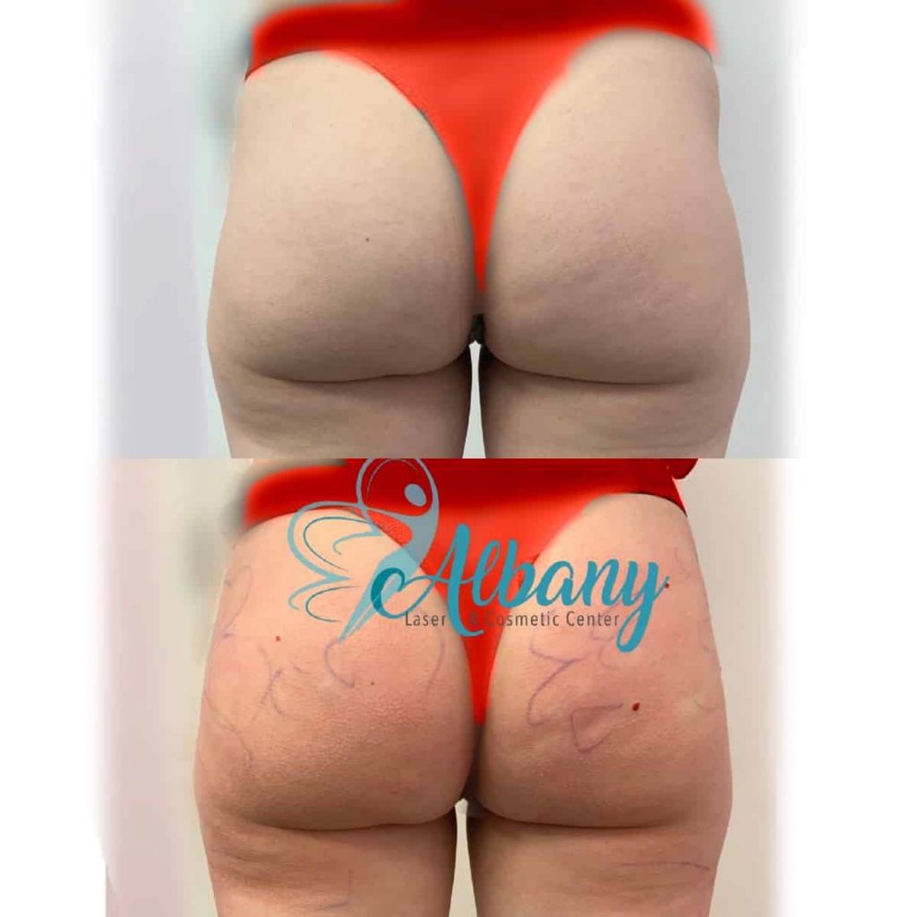 Brazilian Butt Lift