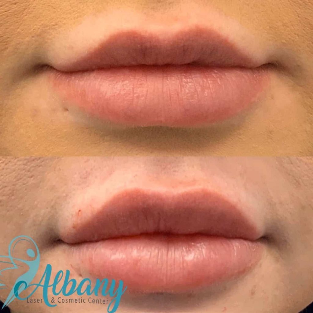 Lip fillers Restylane Kysse Edmonton