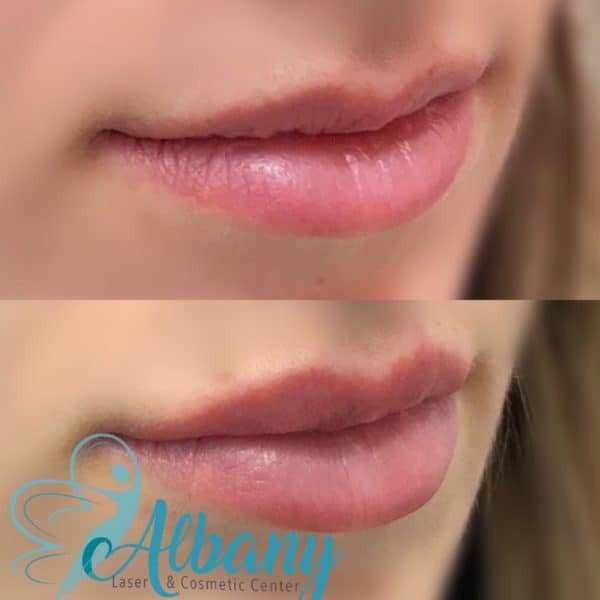 Lip filler injections Edmonton