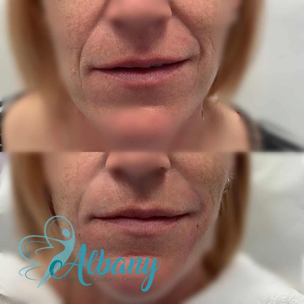 nasolabial folds Edmonton