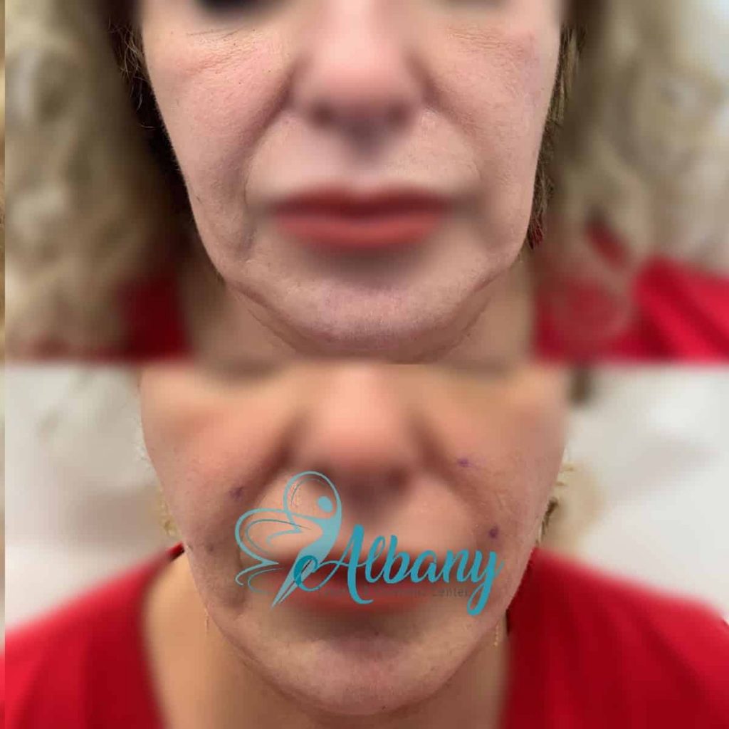 Thread facelift Edmonton