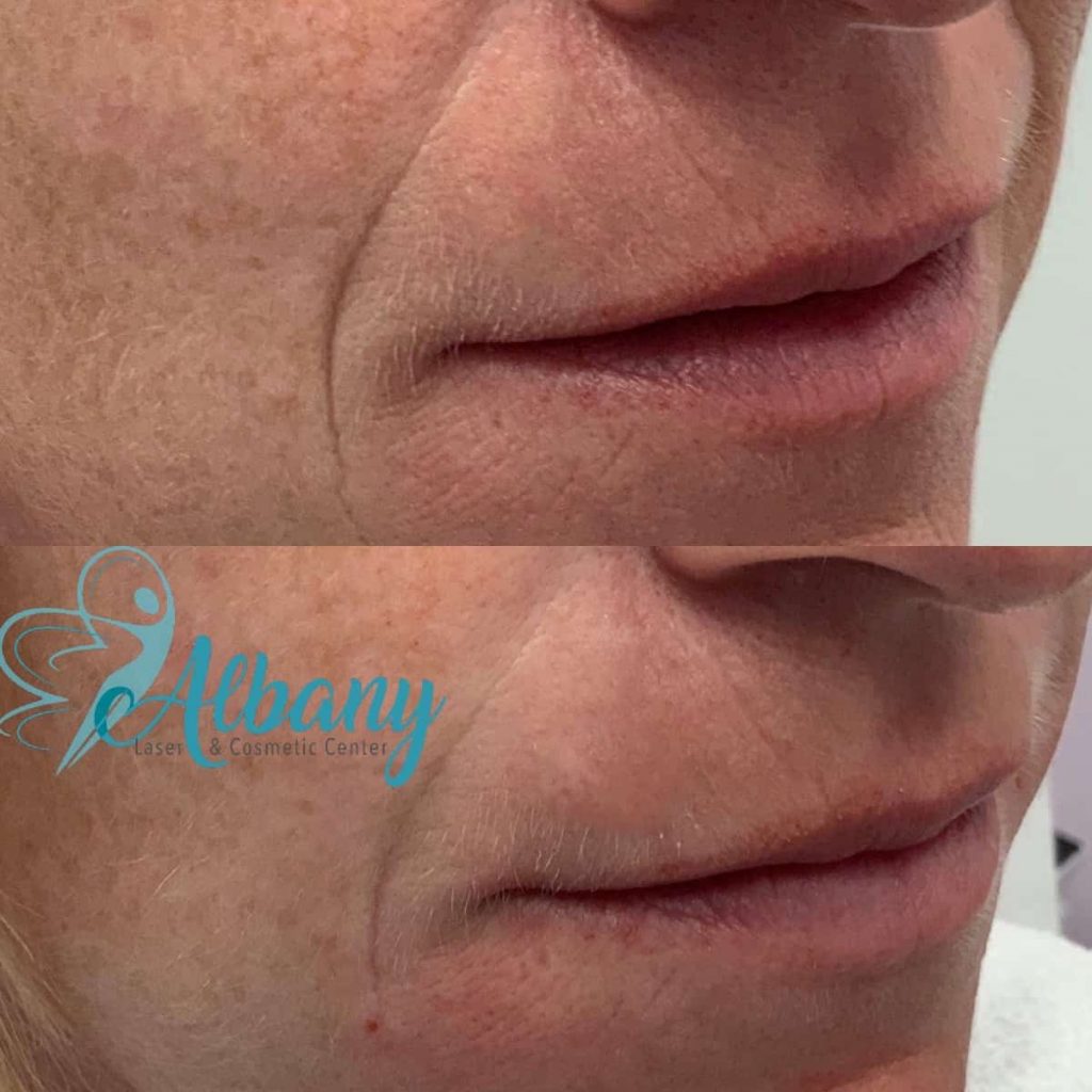nasolabial folds Edmonton