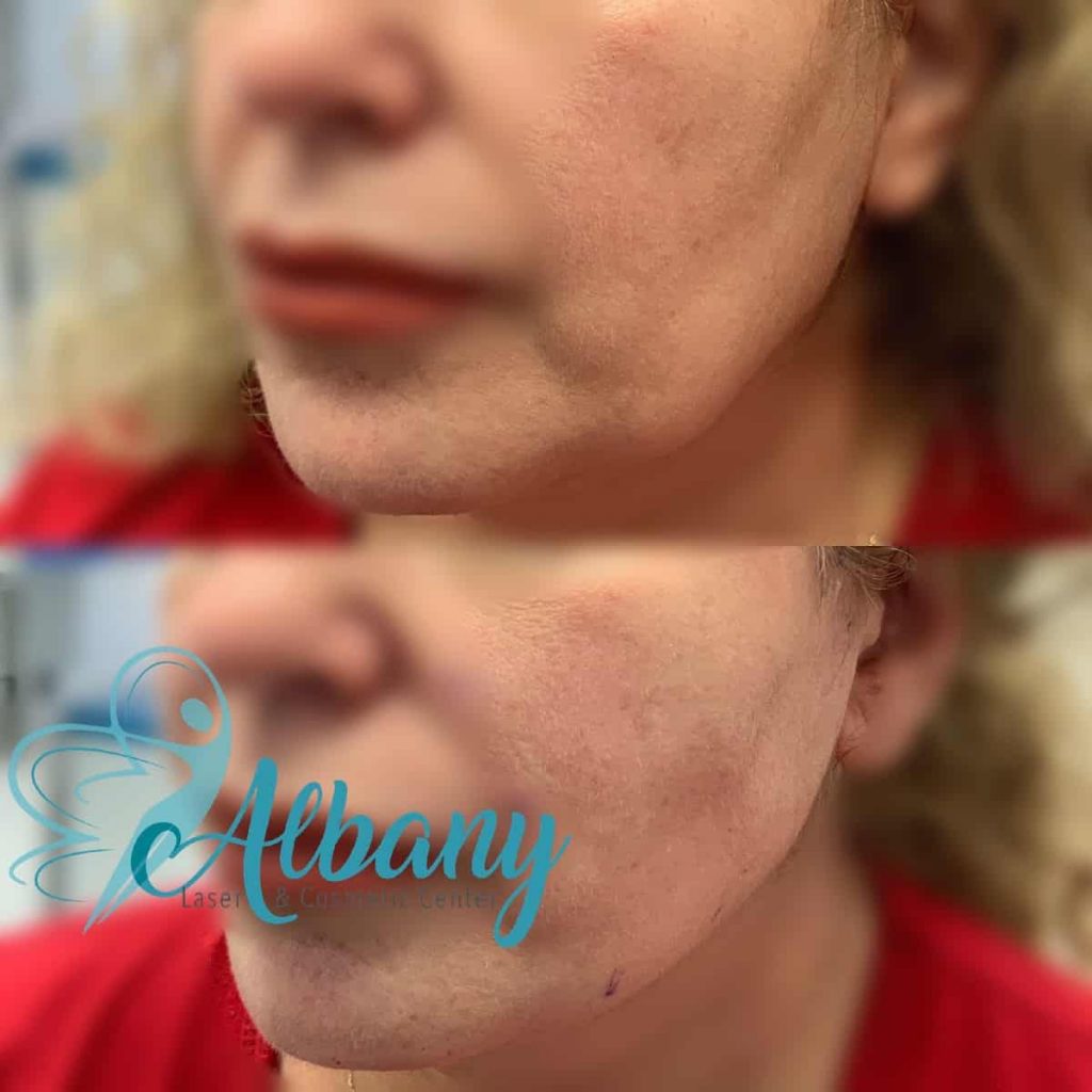 Thread facelift Edmonton