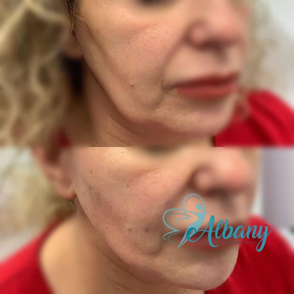 Thread facelift Edmonton