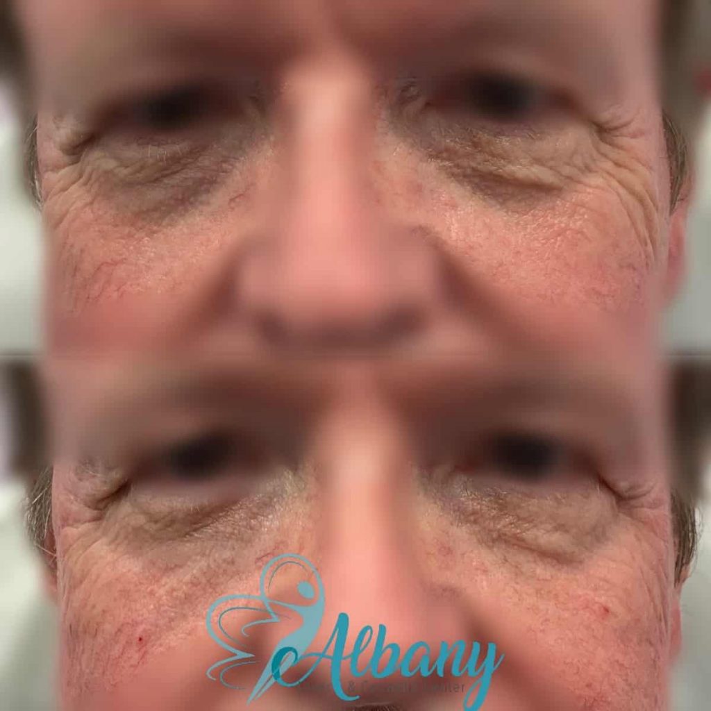 eye wrinkles