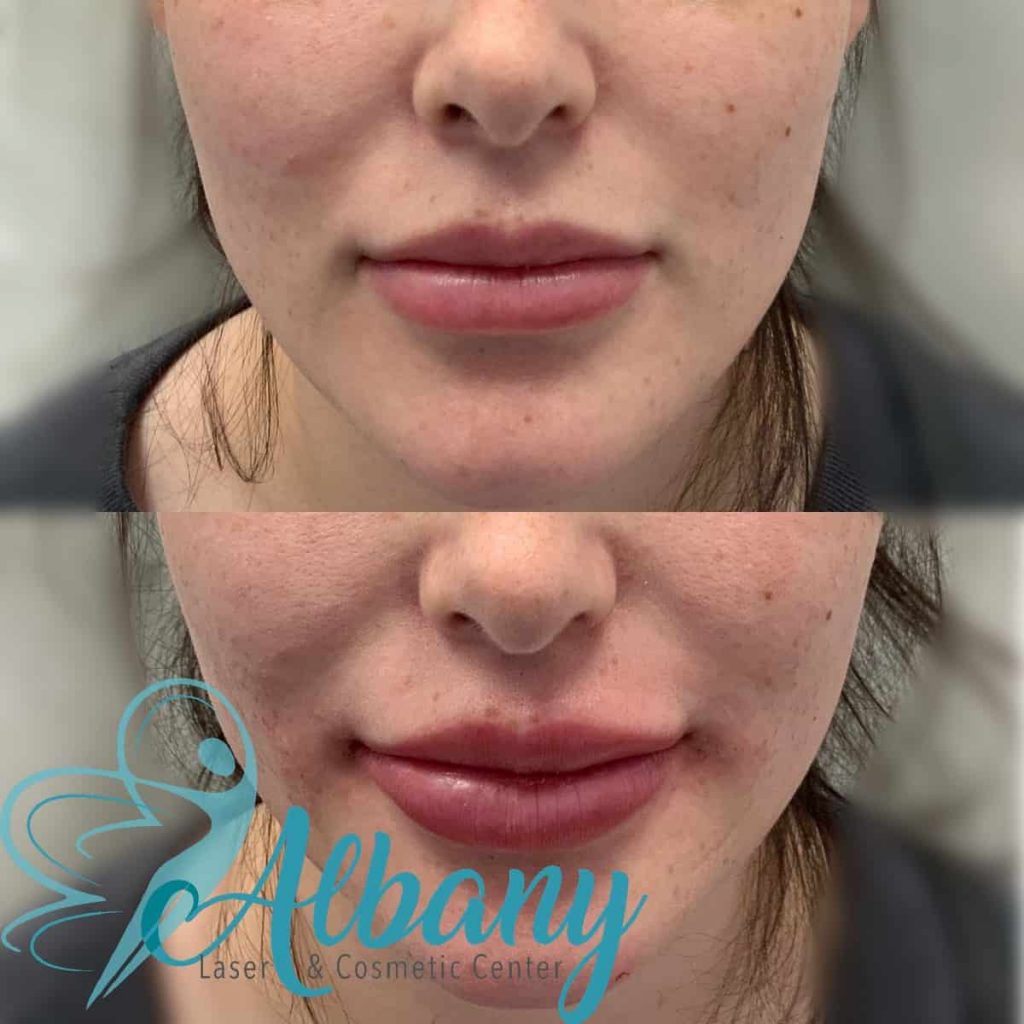 Lip fillers