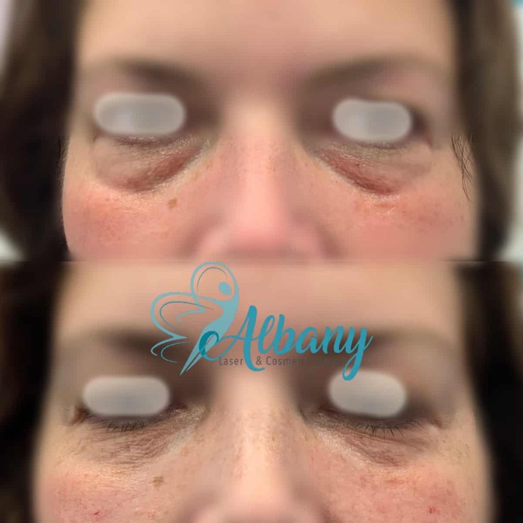 under eye fillers
