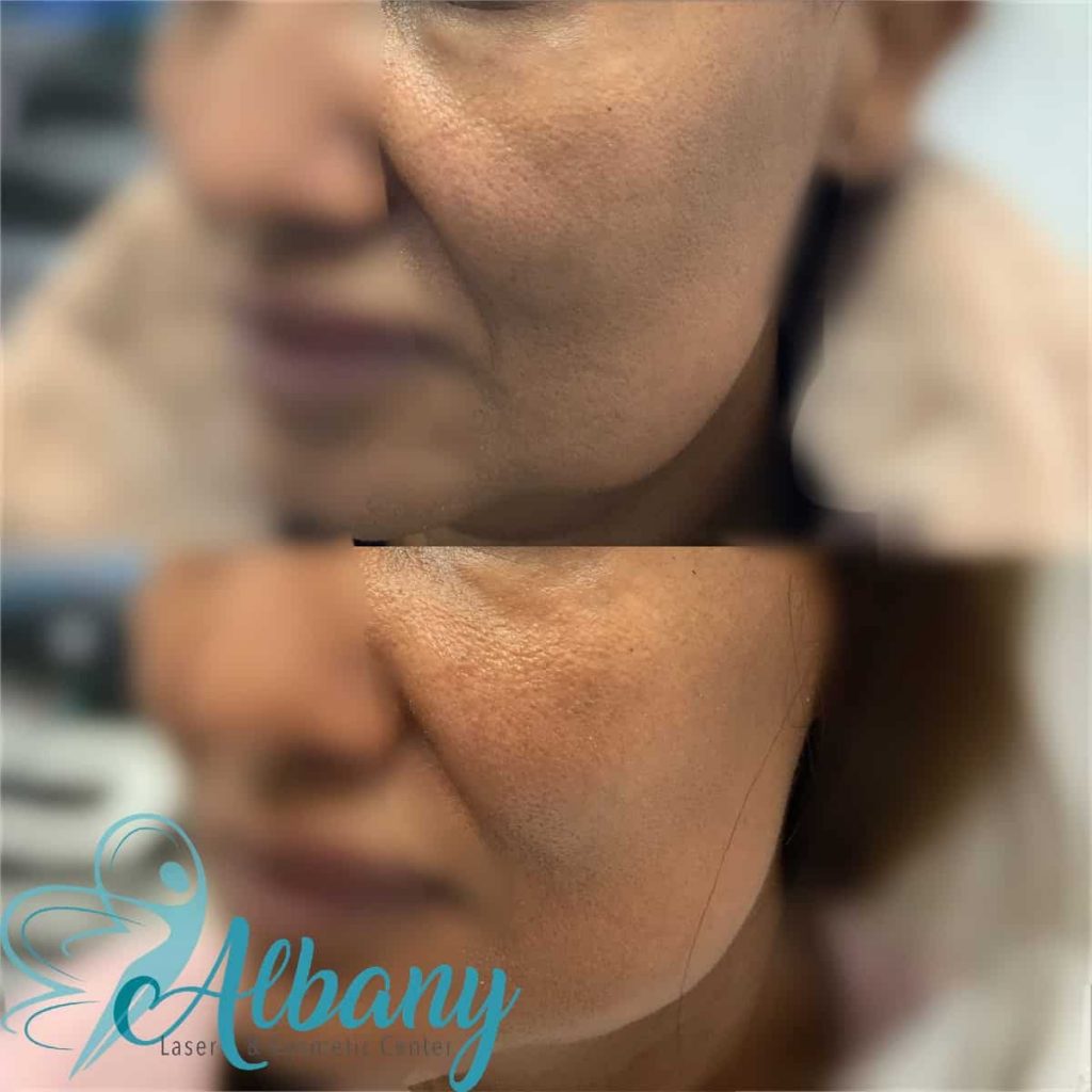 Mid facelift Augmentation