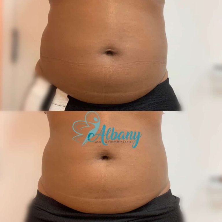 before after coolsculpting Edmonton
