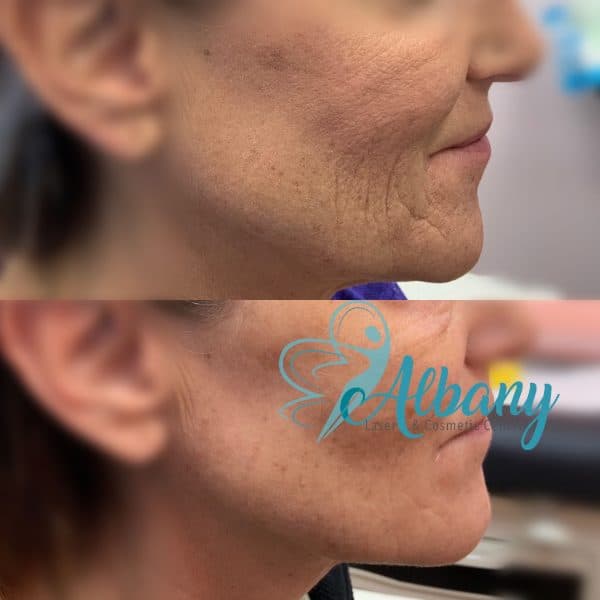 Thread facelift Edmonton