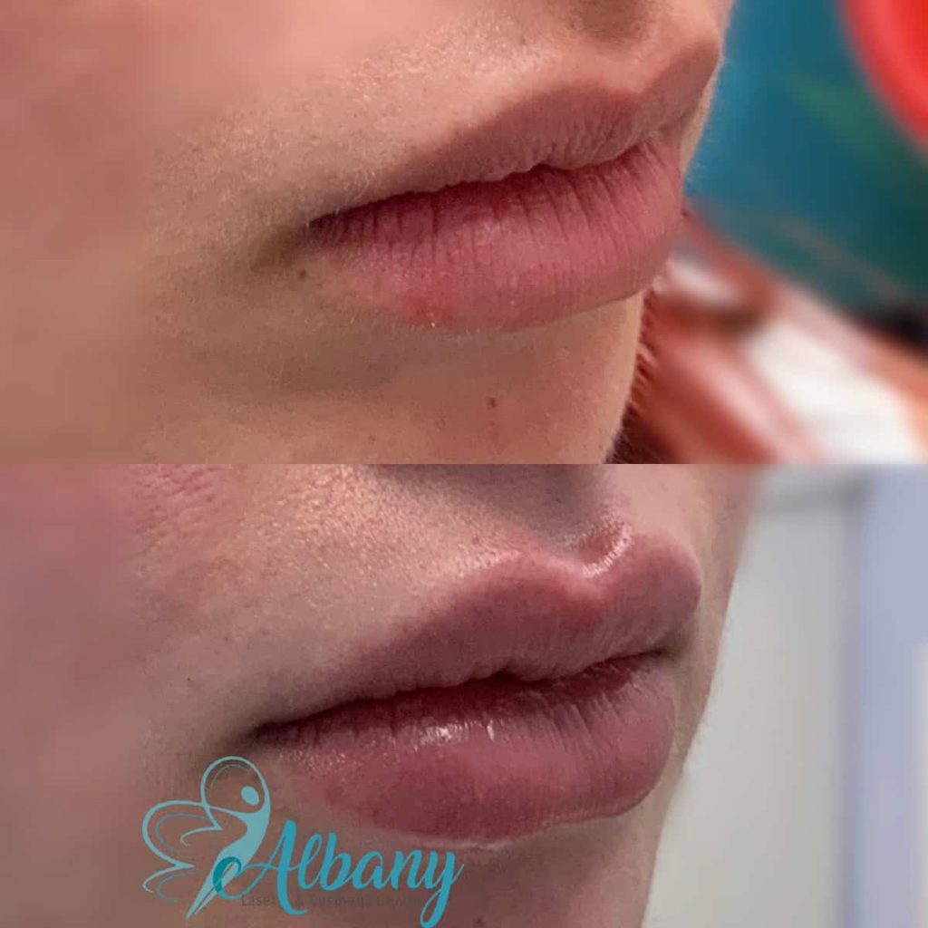 natural look lip fillers