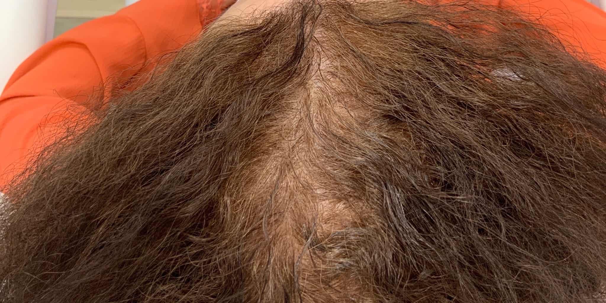 Hair loss before treatment