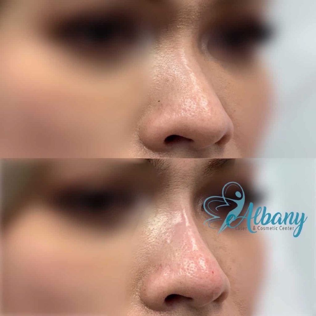 Before and after nose job