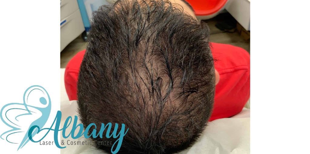 After Hair loss treatment