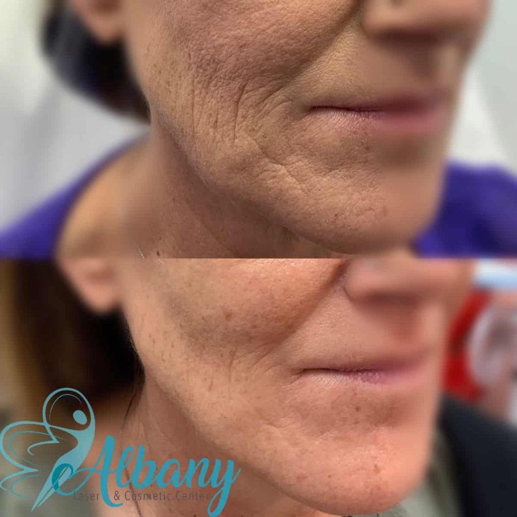 non-surgical facelift Edmonton