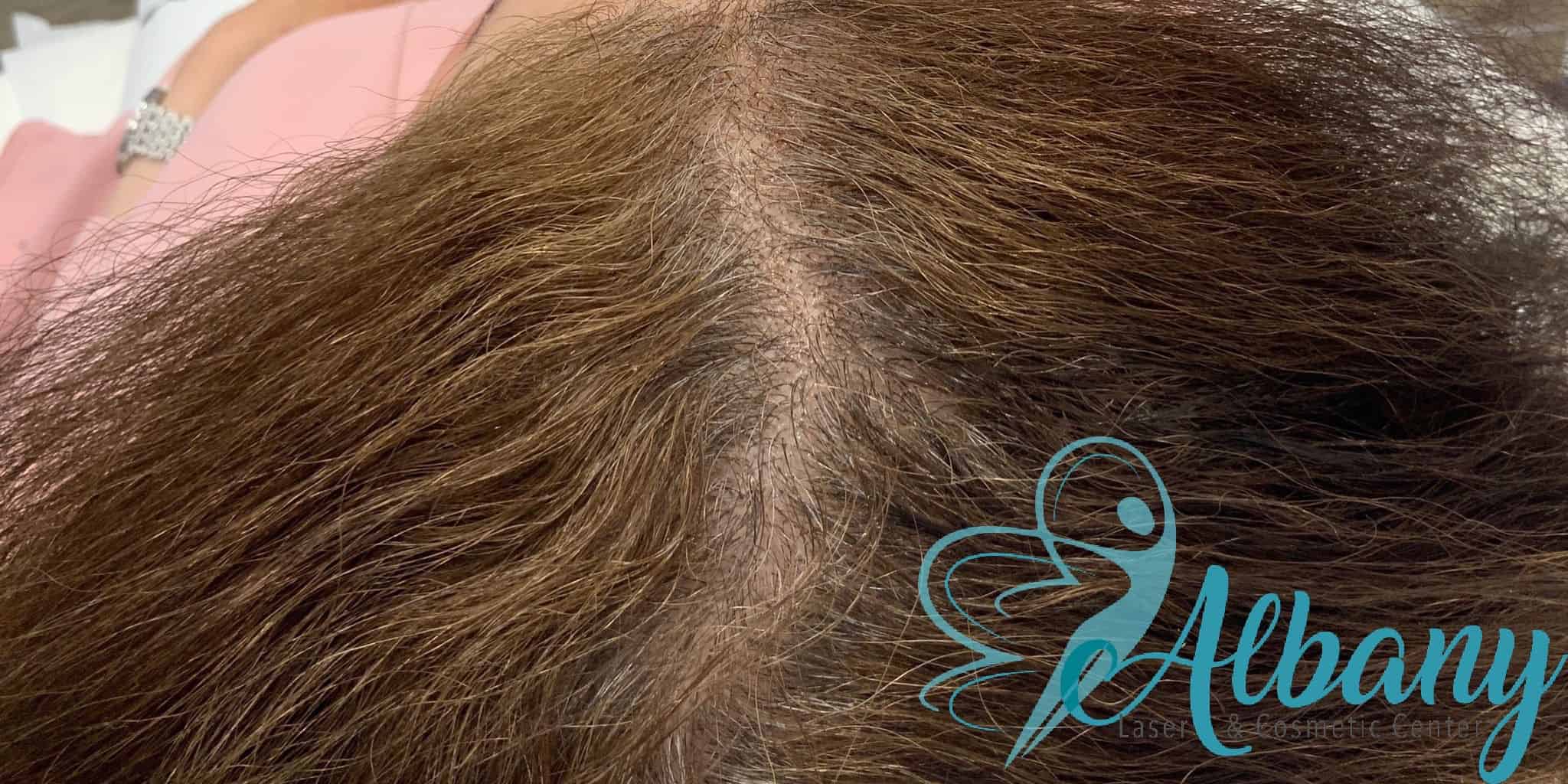 hair loss after treatment