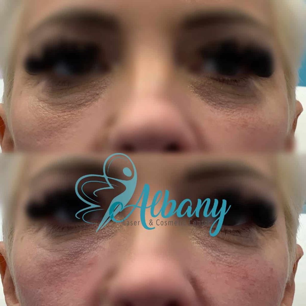 before after Tear trough fillers