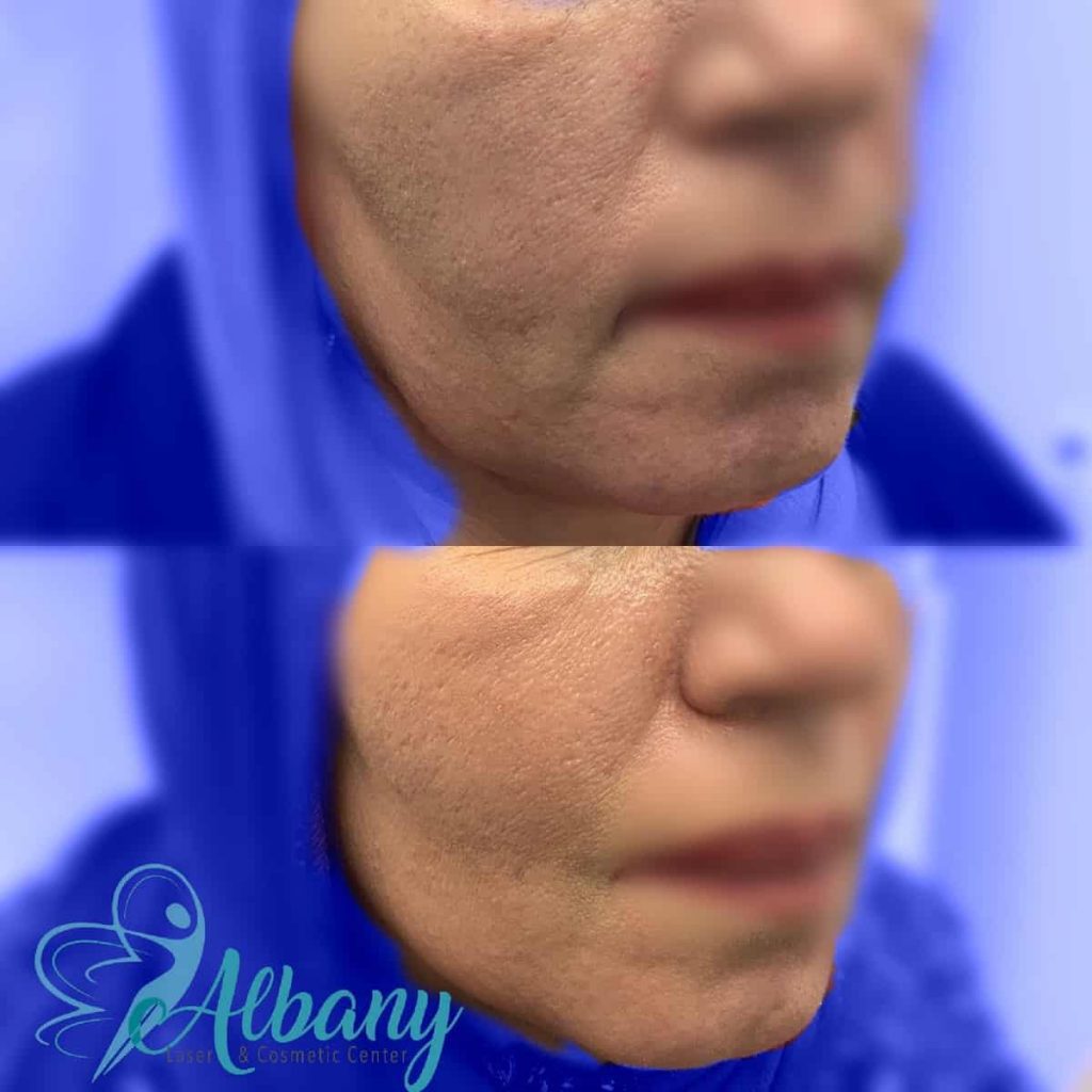 Face Thread lift Edmonton