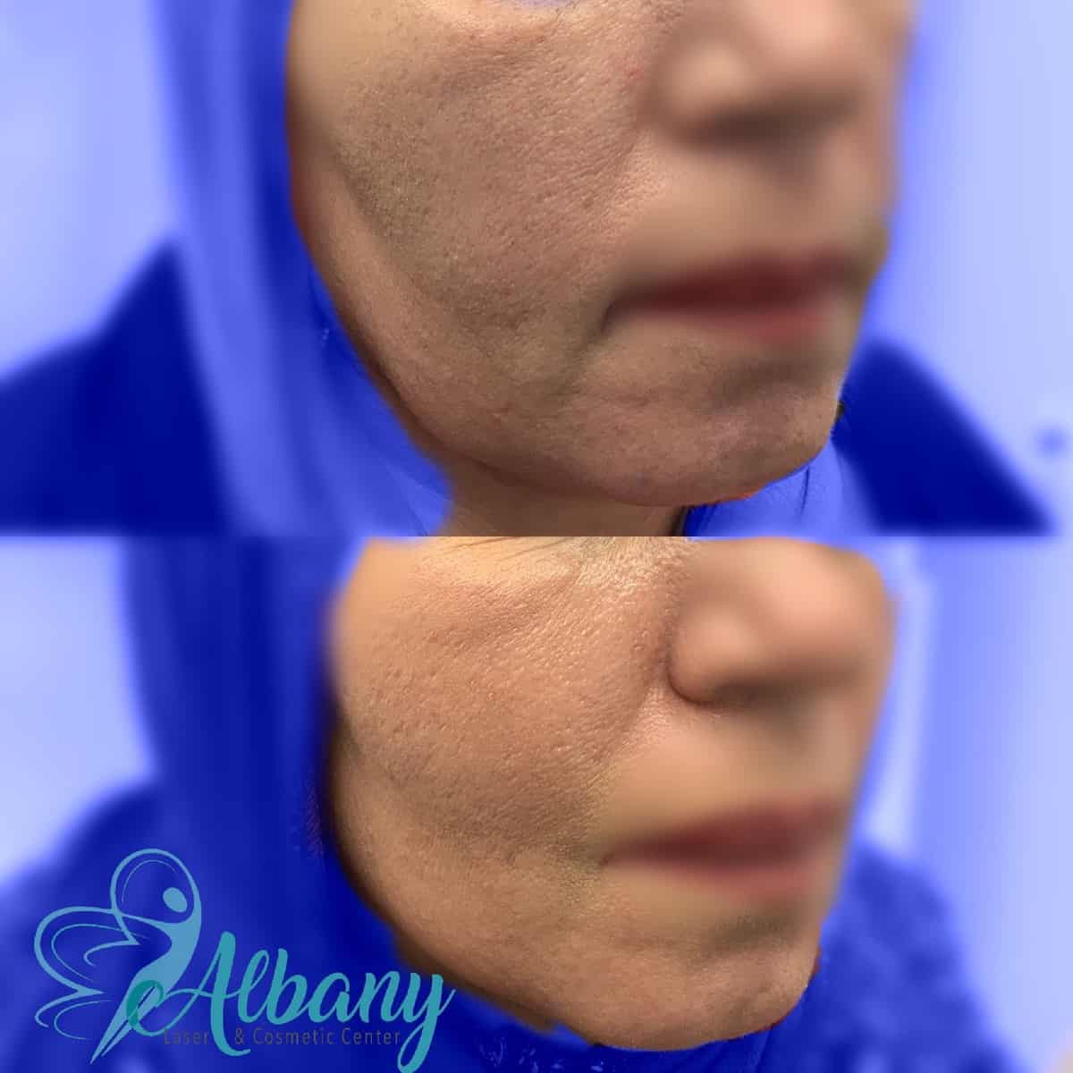 Face Thread lift Edmonton
