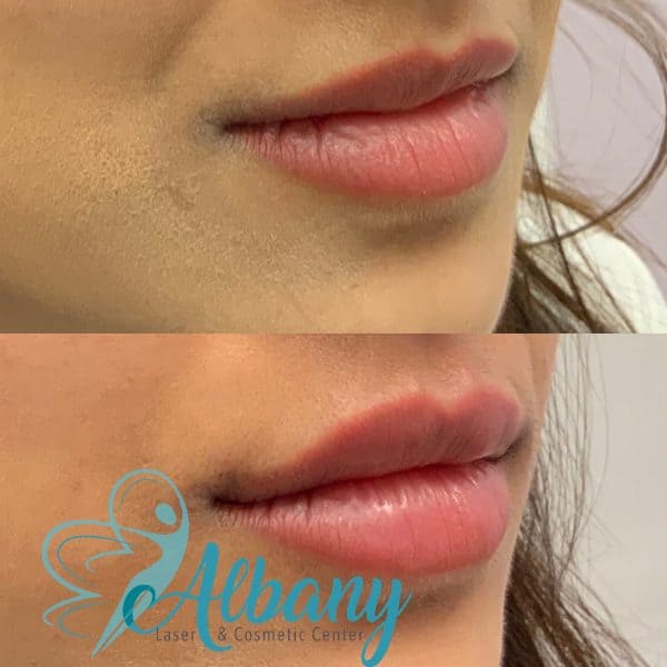 lip fillers Edmonton