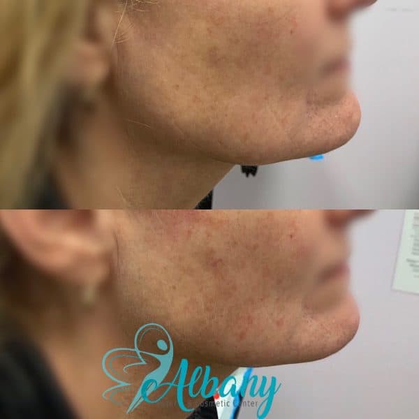 Jawline contouring Edmonton