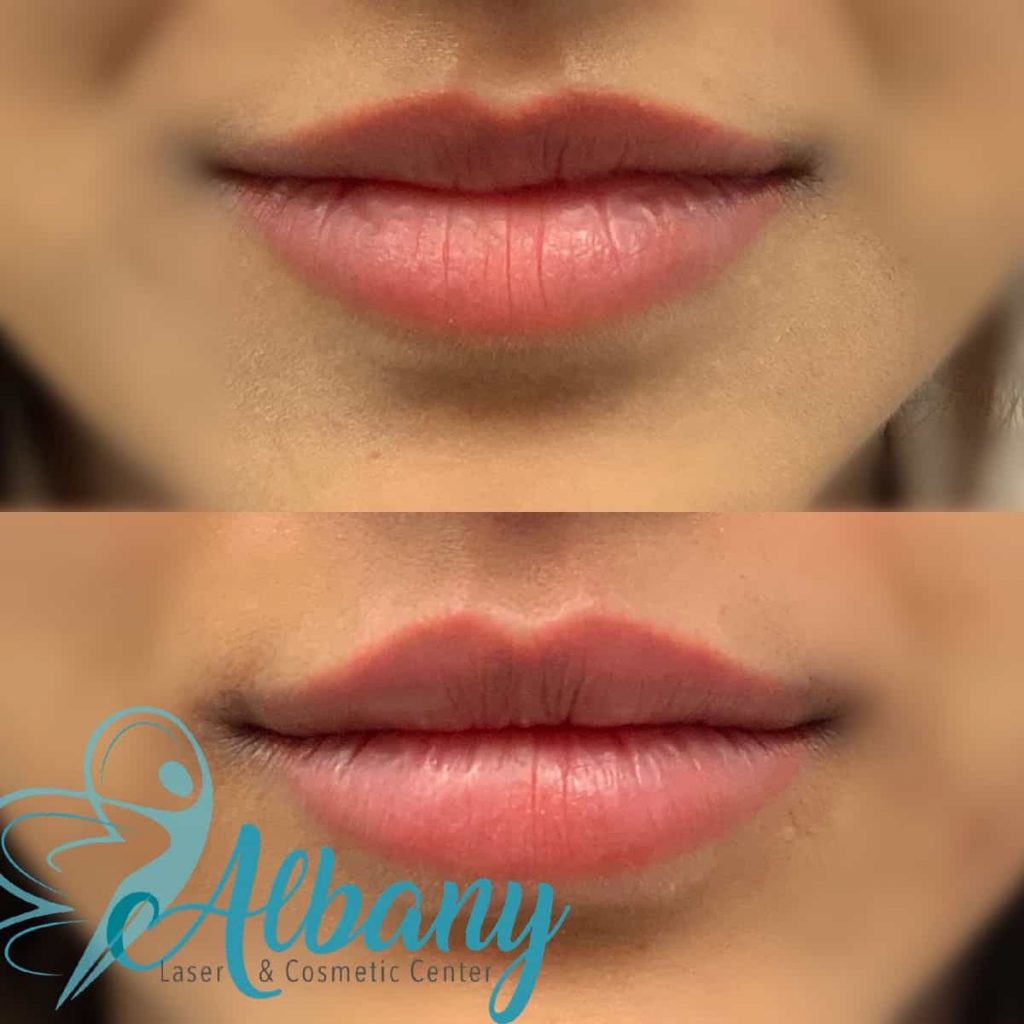 lip fillers Edmonton