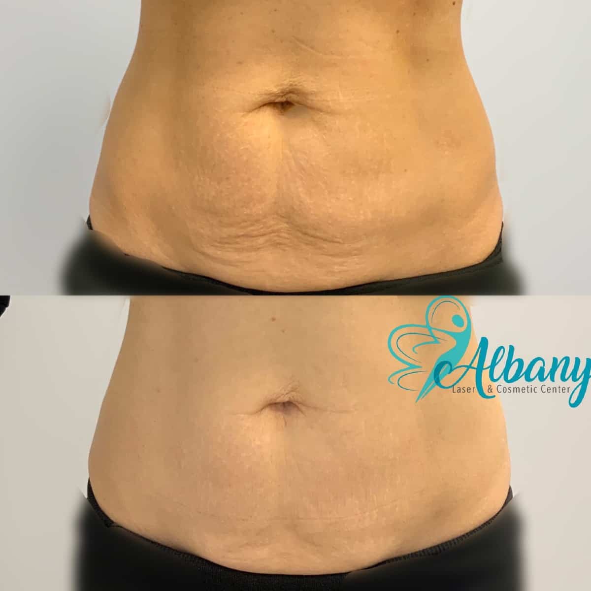 Coolsculpting Results  Albany Laser & Cosmetic Medical Spa