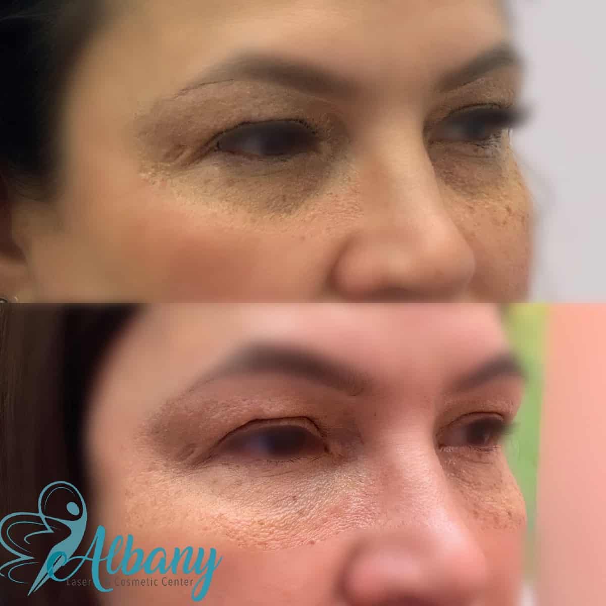 Fraxel Laser for undereye bags  Albany Laser & Cosmetic Center