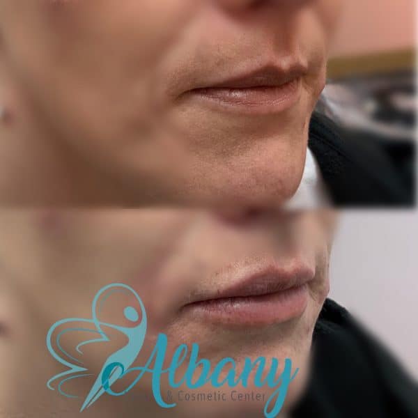 Lip fillers Edmonton