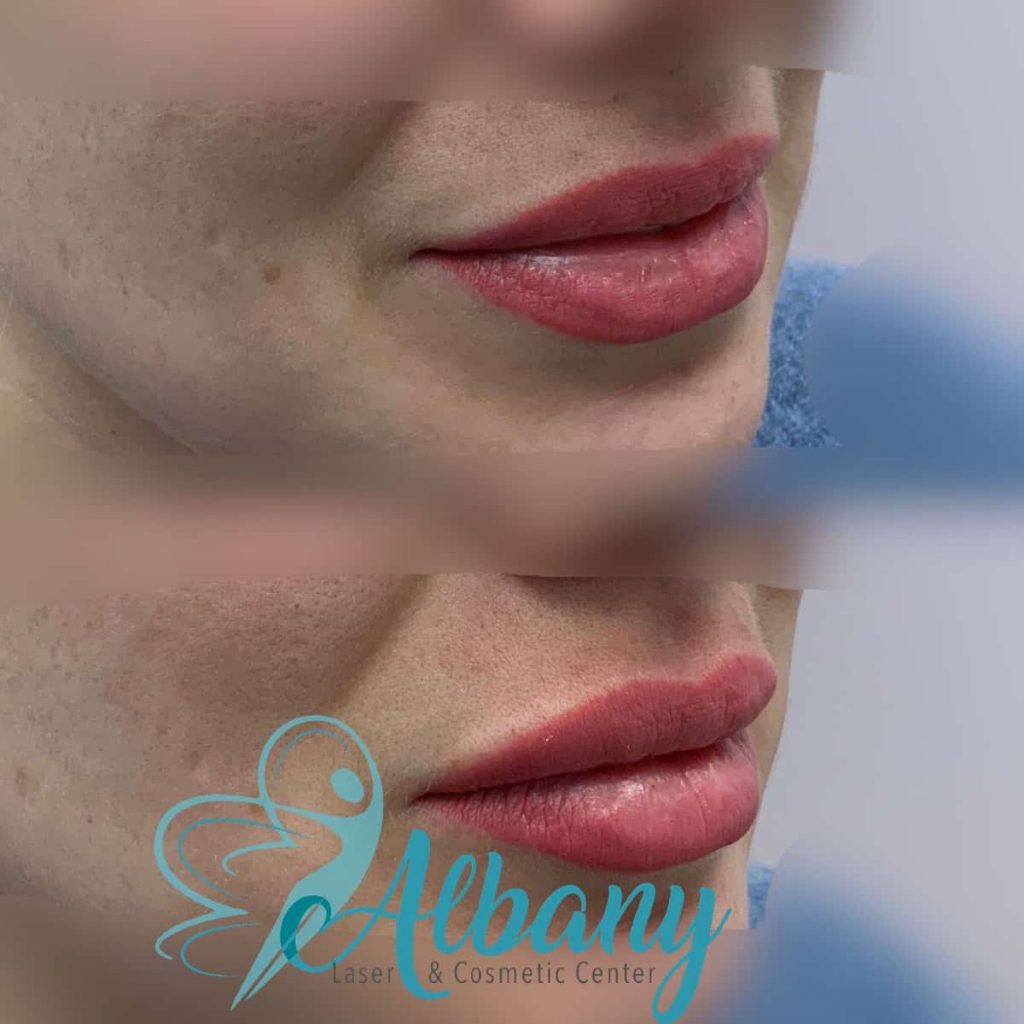 lip fillers injection Edmonton