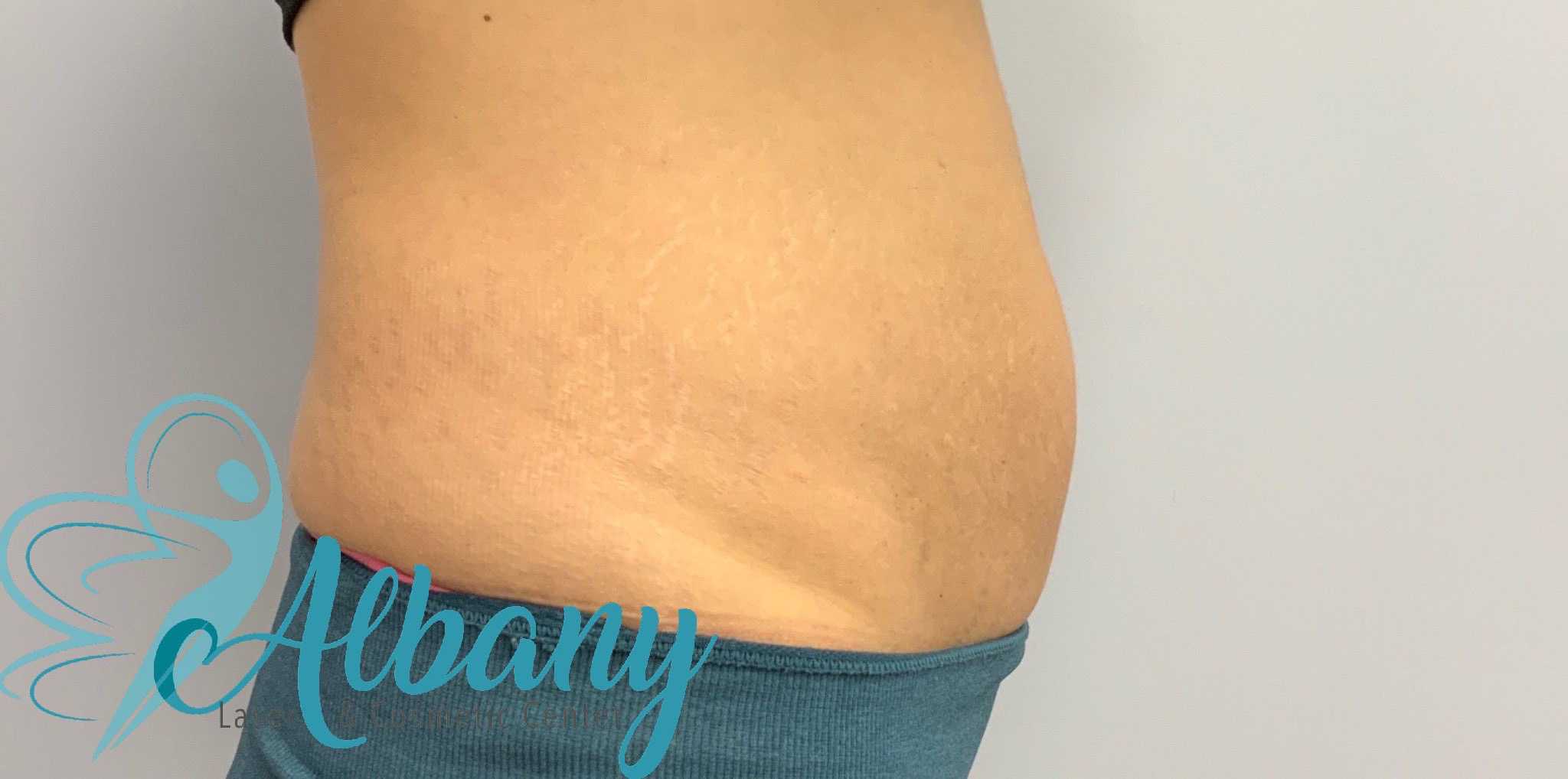 After stretch marks removal