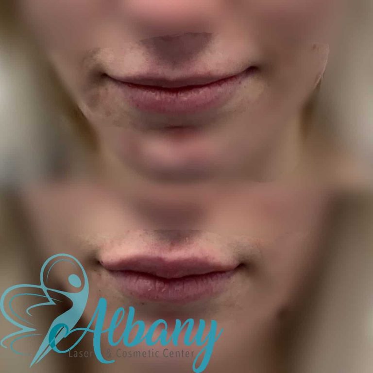 Juvederm lip fillers
