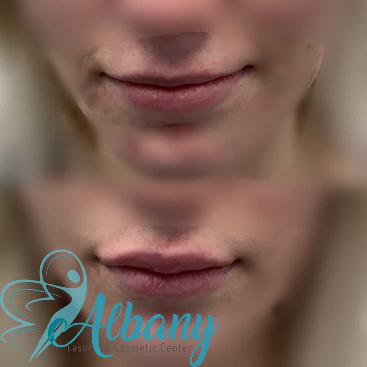 Juvederm lip fillers
