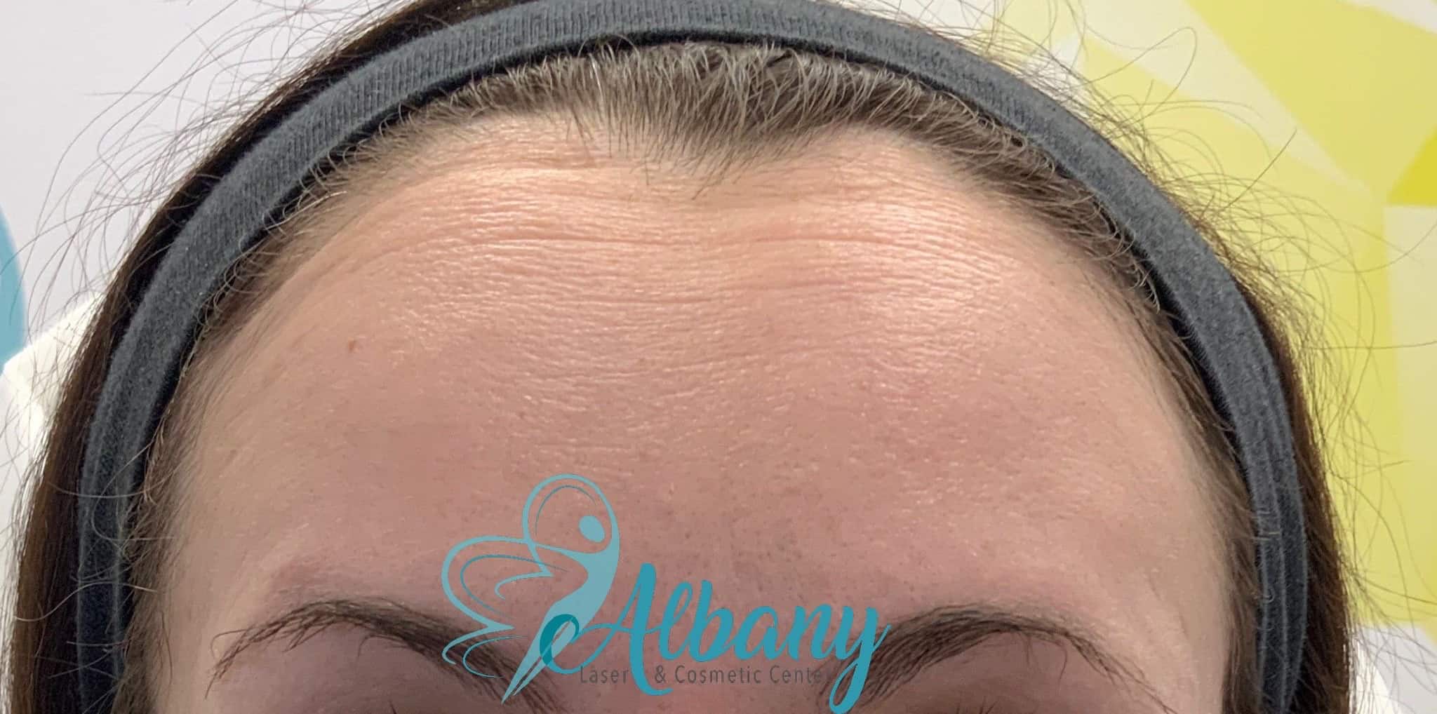 Forehead before Botox treatment, showing lines and wrinkles