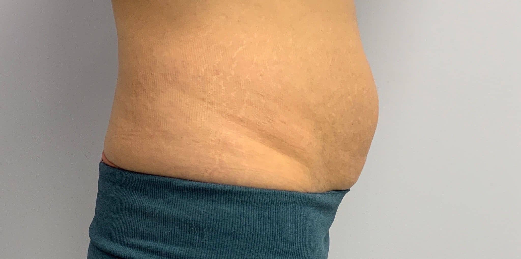 before stretch marks removal