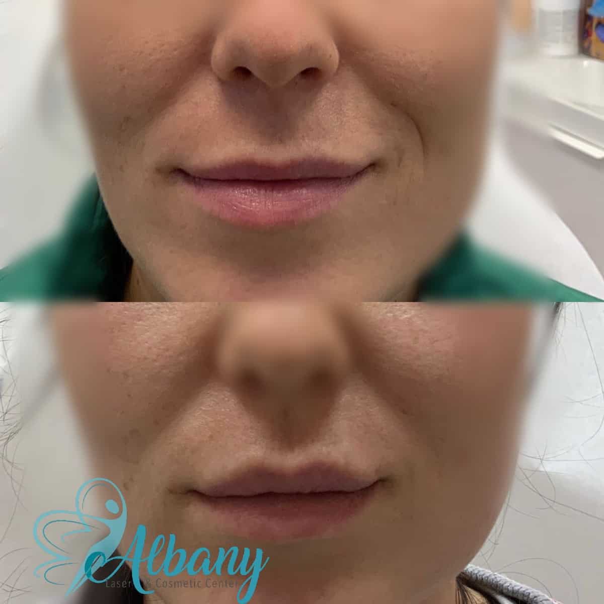 lip filp