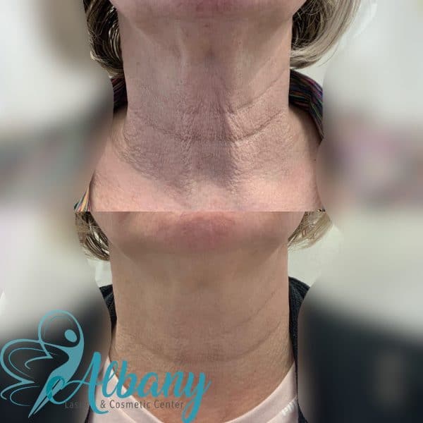 Neck tightening Edmonton